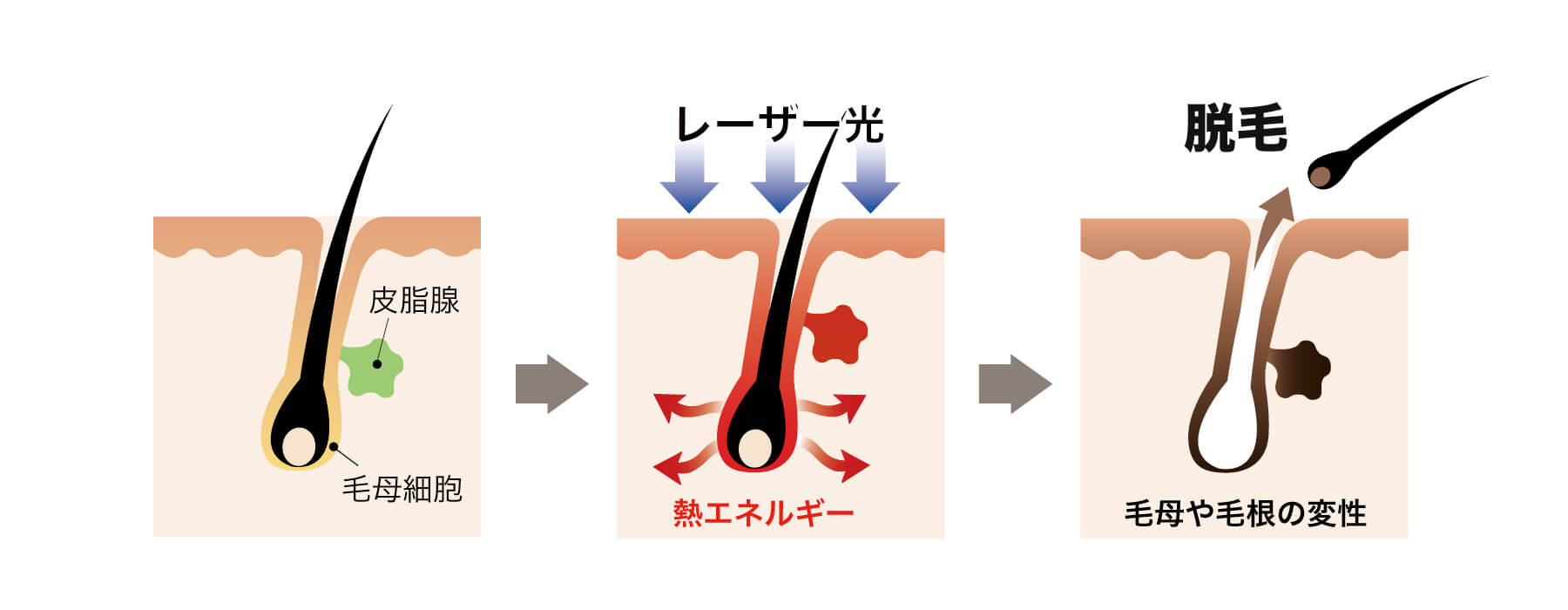 レーザー脱毛は腕や脇に痛みはありますか?