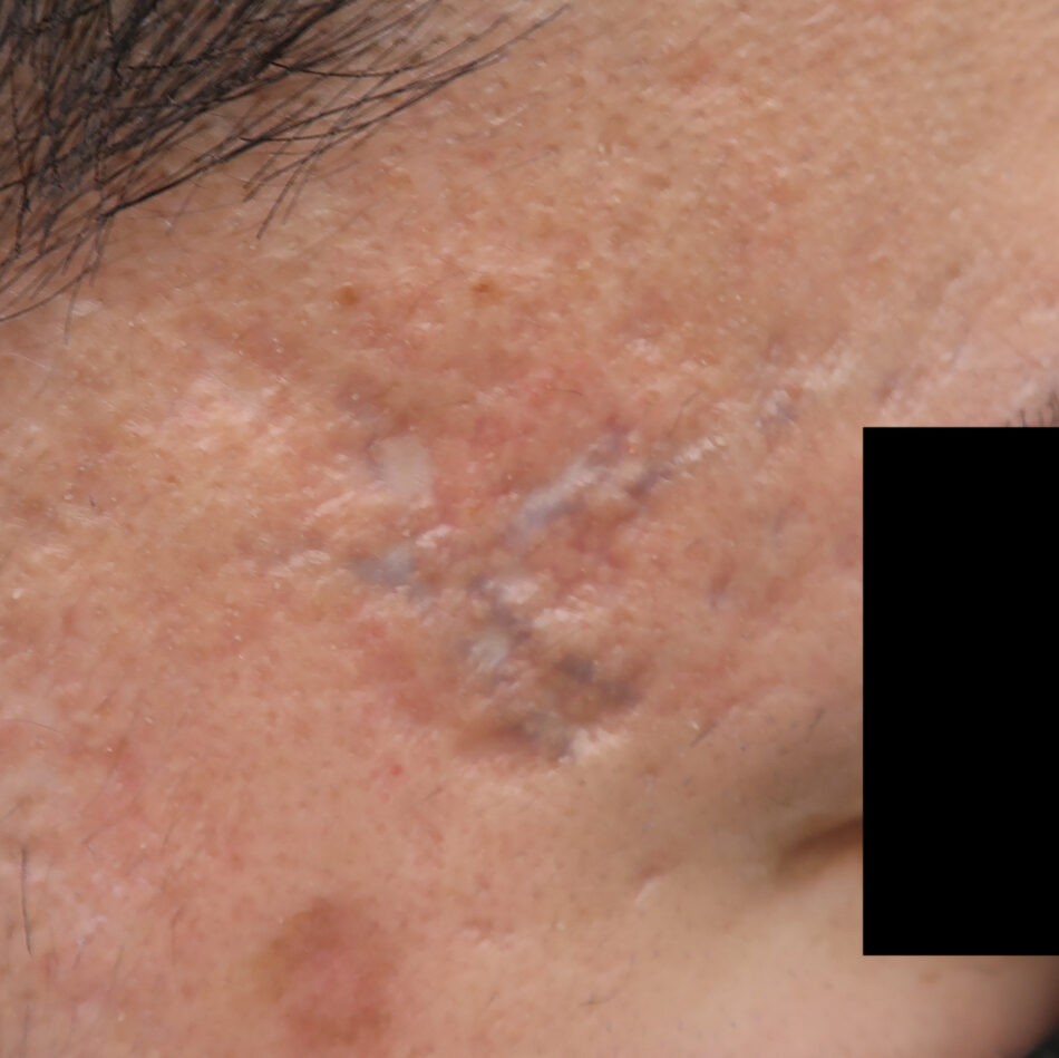 ニキビ跡 症例紹介 はなふさ皮膚科 美容皮膚科 東京 埼玉に9院展開