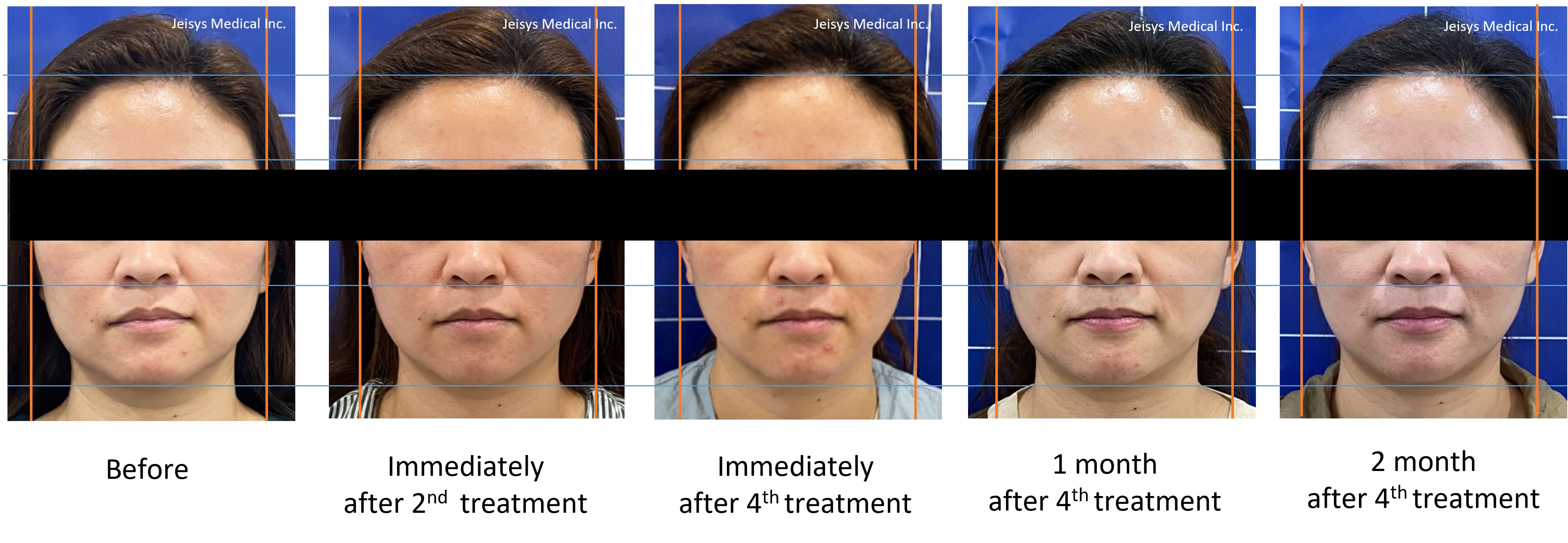 ポテンツァ ダイヤモンドチップ | はなふさ皮膚科・美容皮膚科 関東